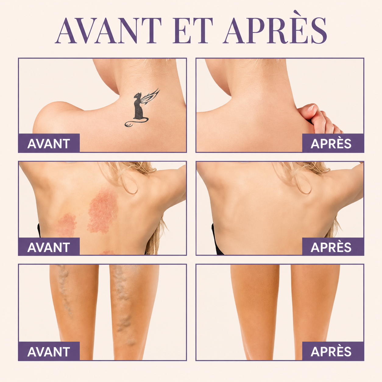 Perfecteur Corps — Camoufle varicosités, vergetures et cicatrices