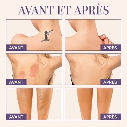 Perfecteur Corps — Camoufle varicosités, vergetures et cicatrices